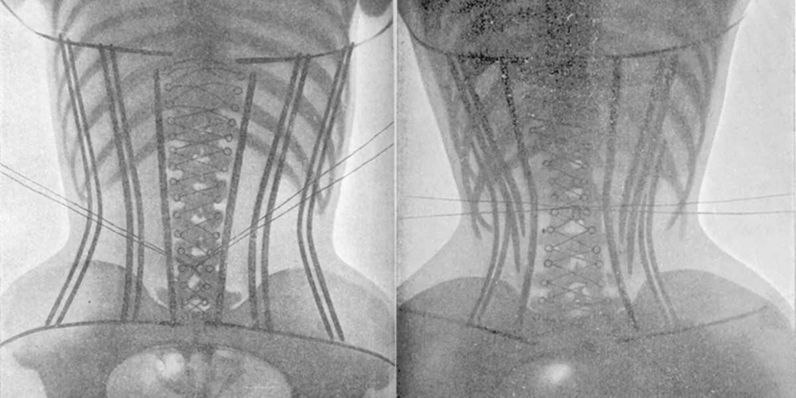 How does tight lacing impact your body?